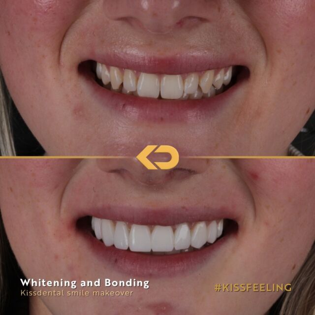 The results speak for themselves! 😍 

Brilliant transformations with our lovely patient Abbie! 🌟 Under the expert care of @drnickjones, Abbie's smile has been completely rejuvenated with a combination of teeth whitening, composite bonding, and gum contouring. ⁠
⁠
If you've been longing for a smile makeover that will leave you feeling  confident, book your consultation with Dr. Nick today. 📲💼 

DM us for more details on how to book 💫✨ 

#SmileMakeovers #SmileTransformations #CompositeBonding #teethwhitening