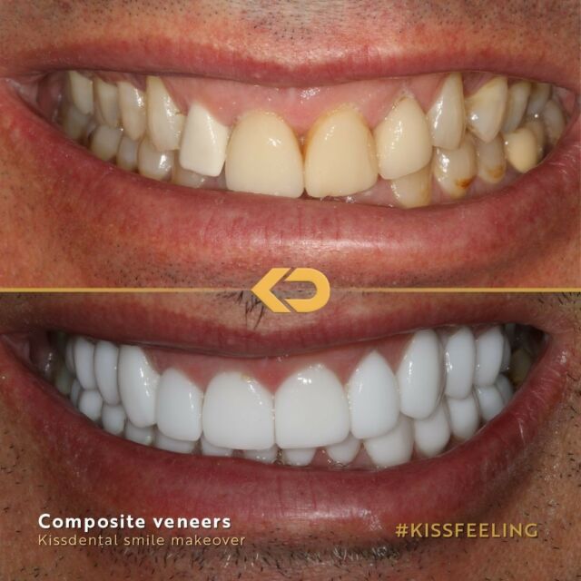 🌟 Introducing Johnathan: another incredible transformation. From a shy smile to a radiant, confident one, his smile makeover results are undeniably life-changing.⁠
⁠
Intrigued? Explore our website gallery to discover more awe-inspiring before and after journeys today! ✨💙 #SmileMakeovers #CompositeVeneers #SummerSmile #KissFeeling #KissDental