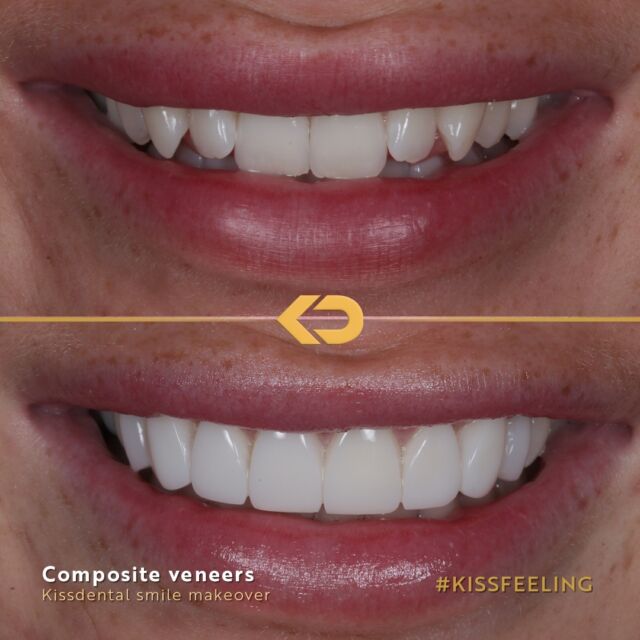 Heading into the weekend with this stunning transformation 😍✨️⁠
⁠
@drkhush_ transformed his patients smile with composite veneers 🦷⁠
⁠
This full treatment was completed in around 2 hours ⏱️⁠
⁠
💬 DM us to book your free consultation⁠
⁠
#compositeveneers #manchesterdentist #liverpooldentist #cheshiredentist ⁠